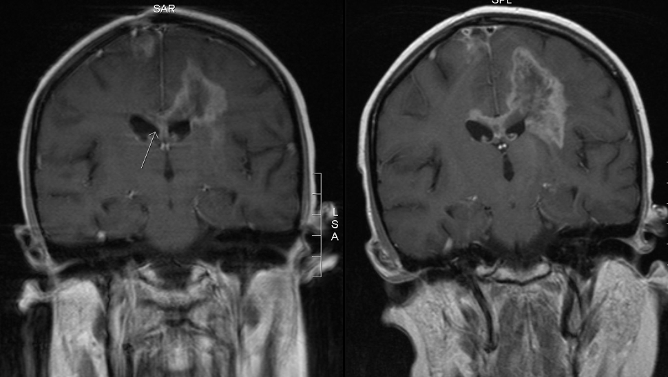 Post-treatment back view MRIs 6 weeks apart, showing dramatic tumor growth