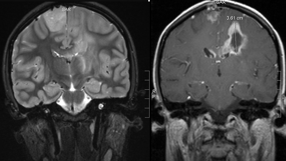 Back view MRI before and after treatment