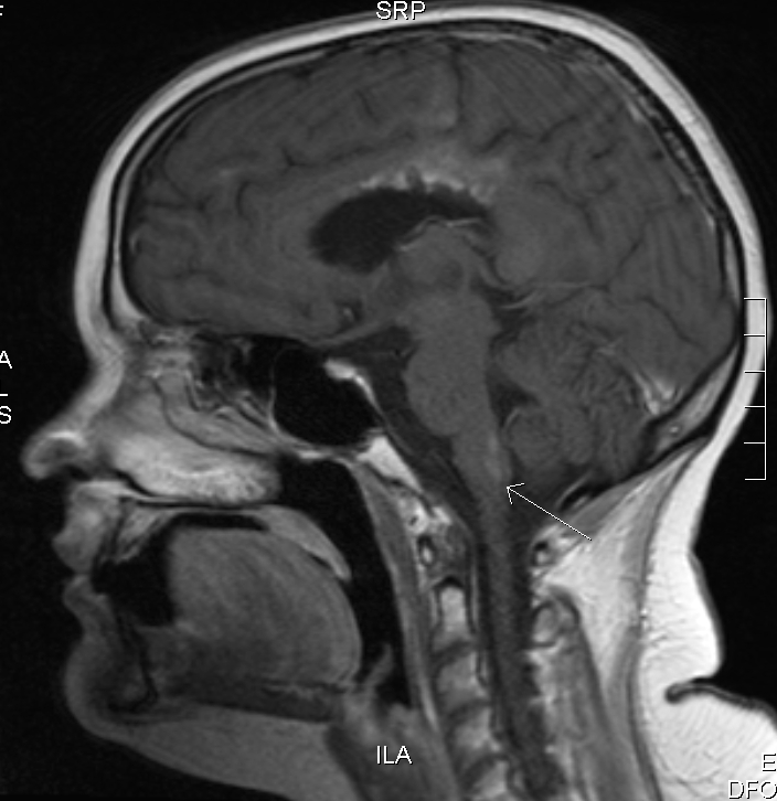 Side view MRI showing brain stem lesion